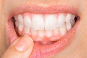 Natural Remedies For Tooth Pain During Emergencies